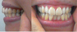 前歯2本に薄いセラミックをくっつけておりますが矯正はできるのでしょうか？