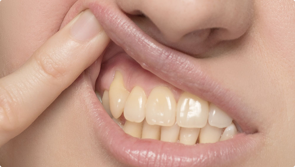 保険の差し歯、歯肉黒ずみ、不自然な差し歯の特徴と原因