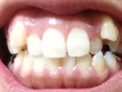 前歯の中心のズレと八重歯が気になる