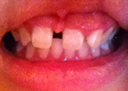 生まれつき上の歯が1本足りないすきっ歯です