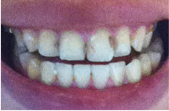 歯の白い斑点 大阪の審美歯科治療 ウメダデンタルクリニック