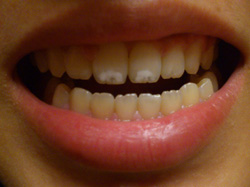 歯の白い斑点 大阪の審美歯科治療 ウメダデンタルクリニック